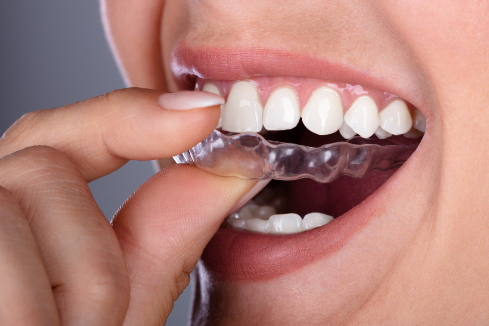 A woman puts in her invisalign clear aligners